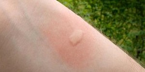 piqure moustique tigre